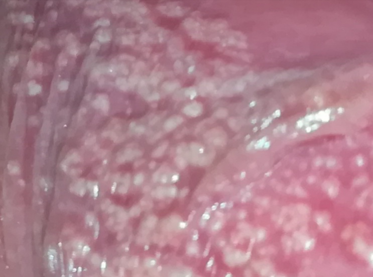 Sind Das Talgdrusen Die Dafur Verantwortlich Sind Dass An Der Innenseite Meiner Schamlippe Weisse Punkte Sind Gesundheit Und Medizin Pflege Vagina Sind Das Talgdrusen Die Dafur Verantwortlich Sind Dass An Der Innenseite Meiner Schamlippe Weisse Punkte Sind Gesundheit Und Medizin Pflege Vagina