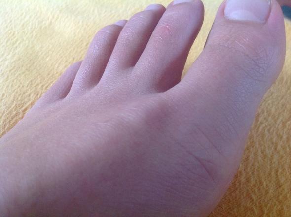 Sind das Überbeine? (Gesundheit, Medizin, Füße)