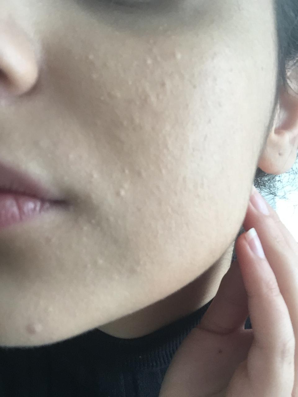 Sind Das Verstopfte Poren Beauty