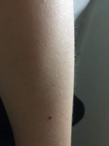 sind das viele haare am arm hormone