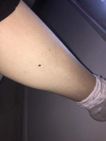 sind das viele haare am arm hormone