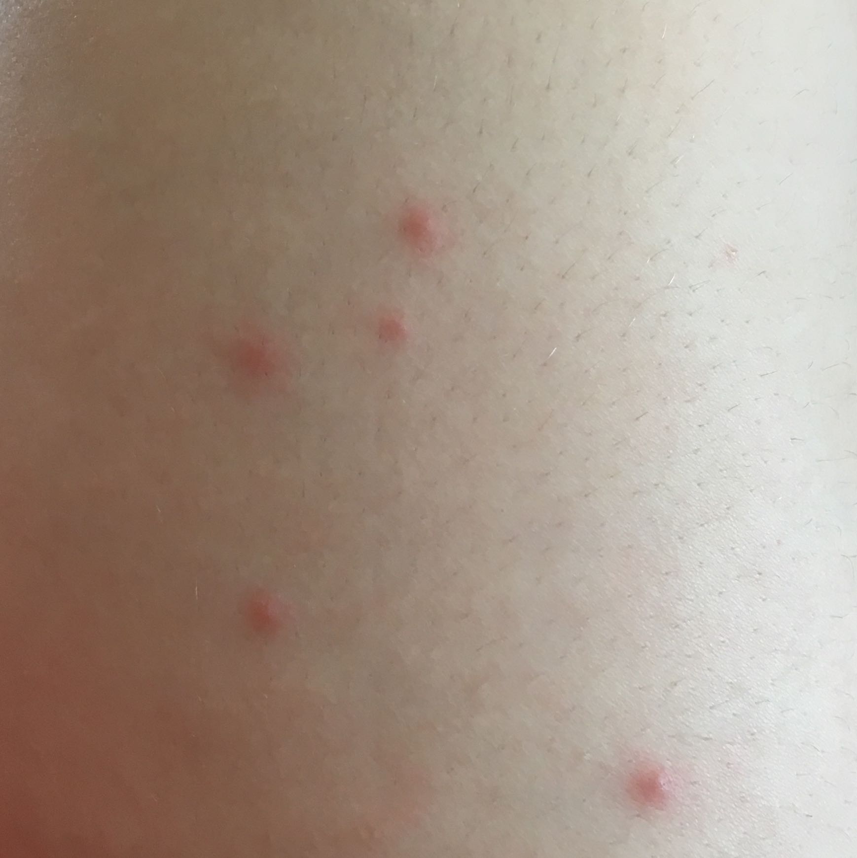 villeicht windpocken oberschenkel