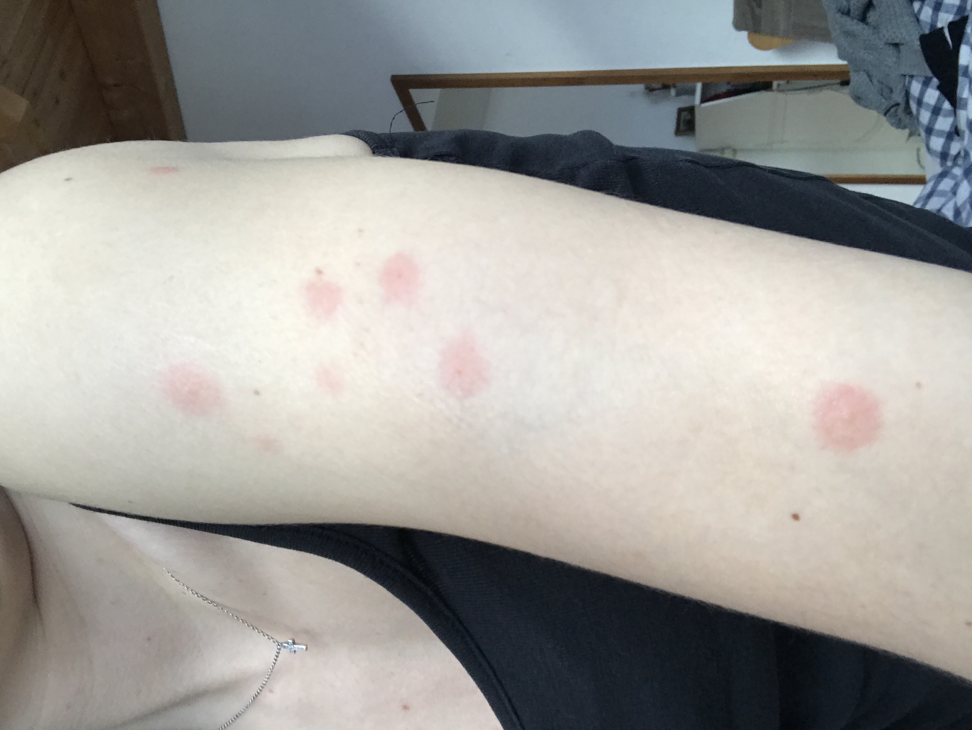 33+ Juckende pusteln wie mueckenstiche bilder , Sind das wirklich Mückenstiche? (Gesundheit, Gesundheit und Medizin