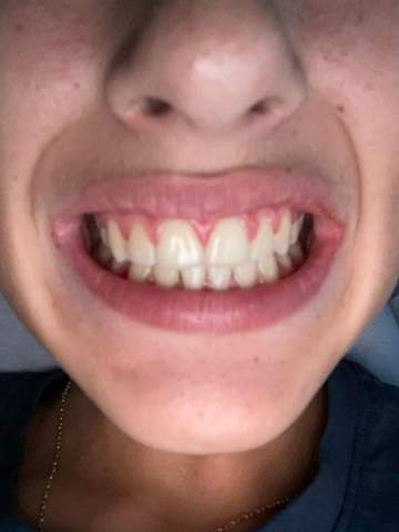 Sind das zu große Zähne?