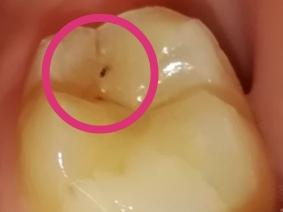 Sind Die Dunklen Stellen Am Zahn Auf Dem Foto Karies Gesundheit Medizin Zahne Sind Die Dunklen Stellen Am Zahn Auf Dem Foto Karies Gesundheit Medizin Zahne