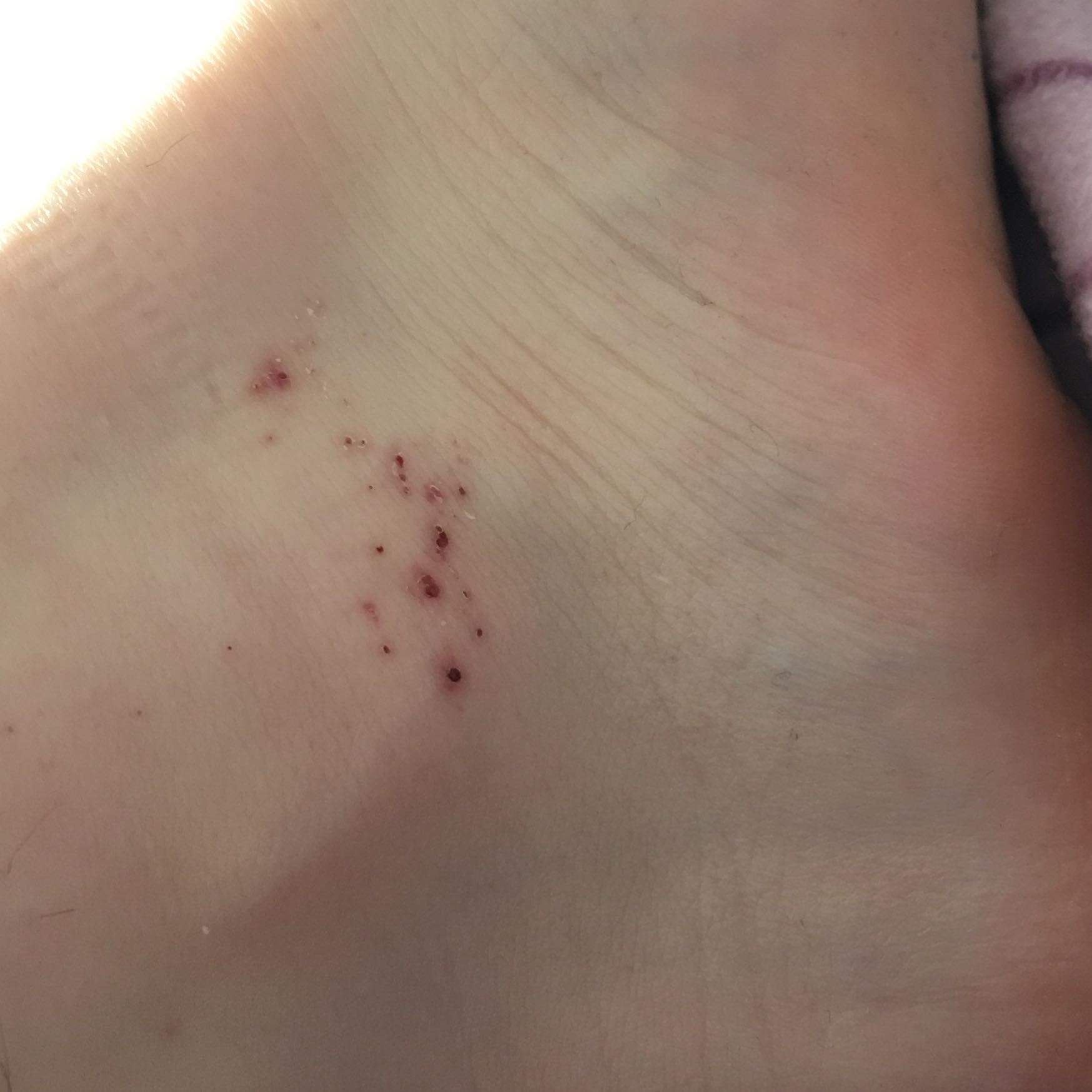 Sind die Flecken und Punkte auf meinem operierten Fuß normal oder ab zum Arzt? (Gesundheit und Sind die Flecken und Punkte auf meinem operierten Fuß normal oder ab zum Arzt? (Gesundheit und