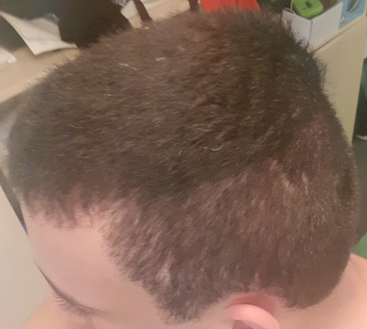 sind diese grauen haare normal fur