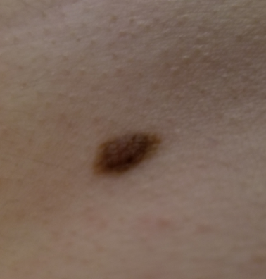 Sind diese Leberflecken gefährlich? (Gesundheit und Medizin, Haut, Gefahr)