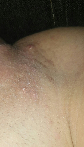 Sind Diese Pickel Im Intimbereich Harmlos Sind Diese Pickel Im Intimbereich Harmlos