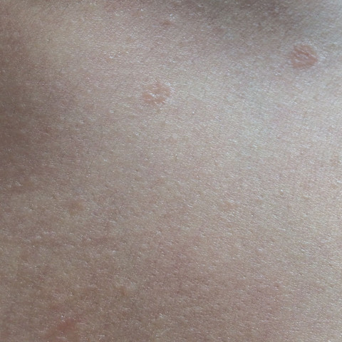 Sind Diese Pickel Was Schlimmes Auf Der Linken Brust Sind Diese Pickel Was Schlimmes Auf Der Linken Brust