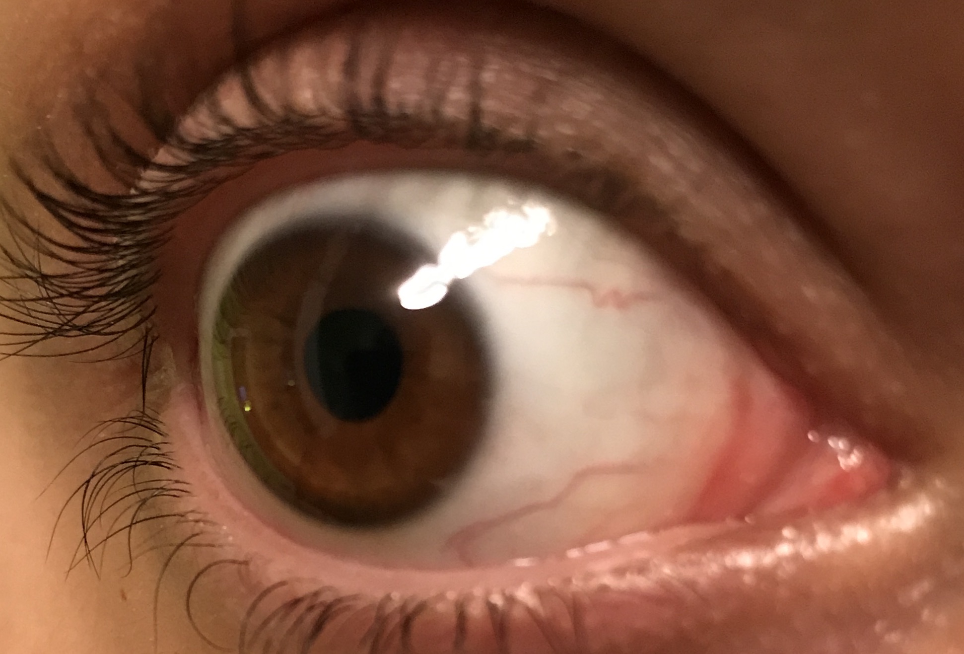 Sind Diese Roten Aderchen Im Auge Normal Gesundheit Und Medizin Medizin Augen Sind Diese Roten Aderchen Im Auge Normal Gesundheit Und Medizin Medizin Augen