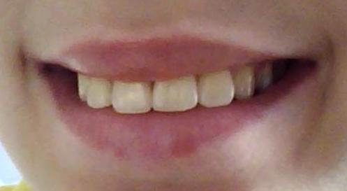 Hässliche Zähne - (Beauty, Zähne, hässlich)