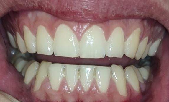 Sind meine Eckzähne (Unterkiefer) lang oder bildet sich das Zahnfleisch zurück?