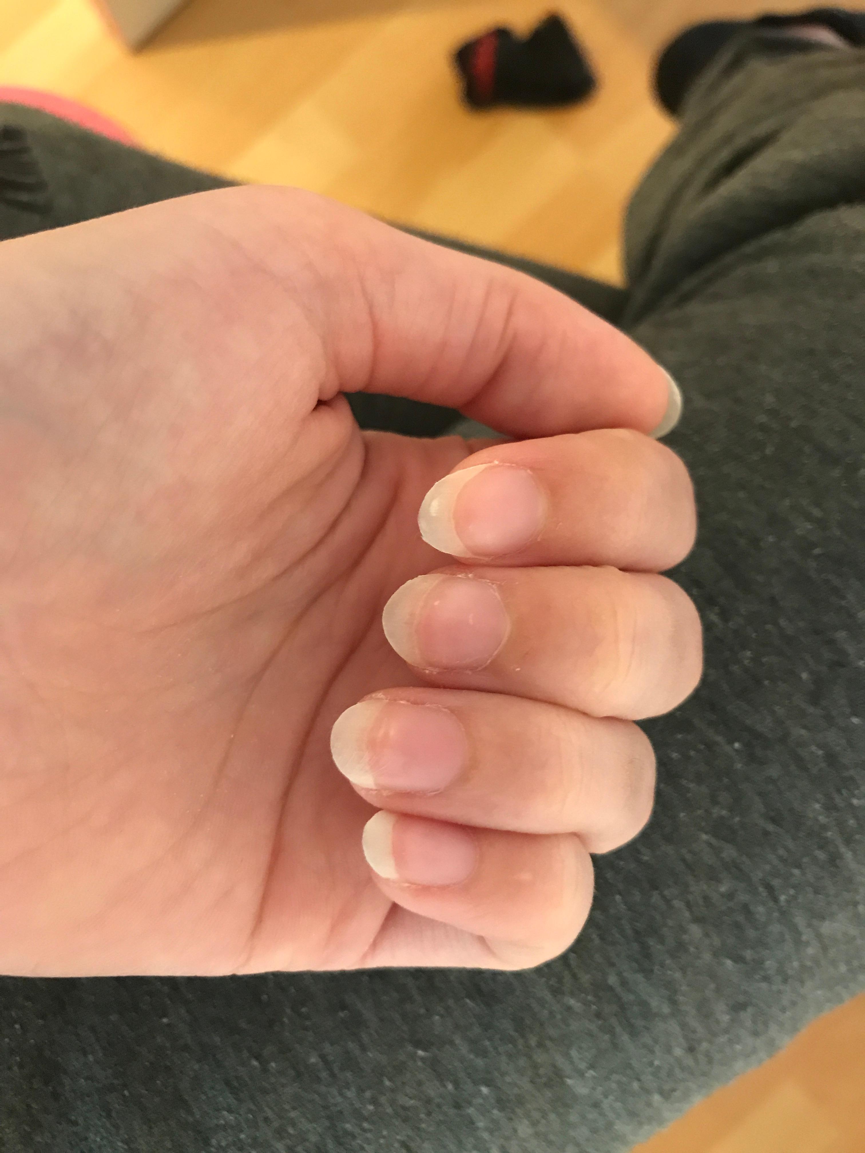 Sind Meine Nagel Schon Aussehen Fingernagel