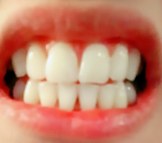 Sind meine Zähne schief?