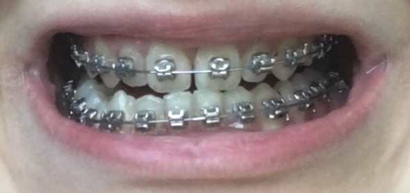Zähne - (Medizin, Zähne, Zahnspange)