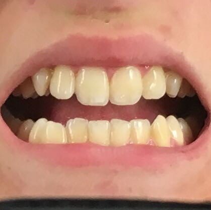 meine Zähne (hier auf dem Bild sind sie ein Bisschen weisser als in echt.. - (Gesundheit und Medizin, Zähne, Hygiene)