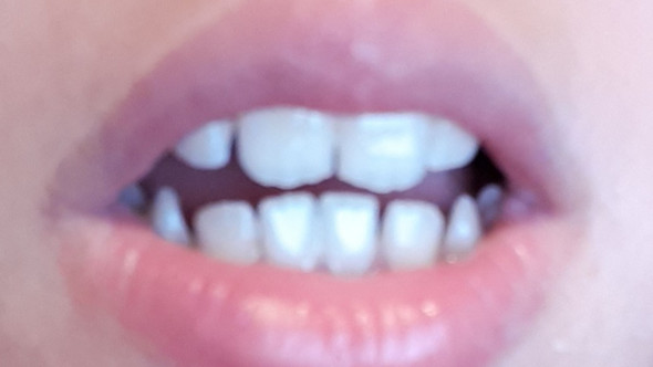 Sind Meine Zahne Zu Klein Fur Brackets Gesundheit Und Medizin Gesundheit Angst