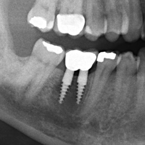 Knochenentzündung bei Zahn-Implantat - (zahnimplantat, Zahnprobleme, Knochenentzündung)