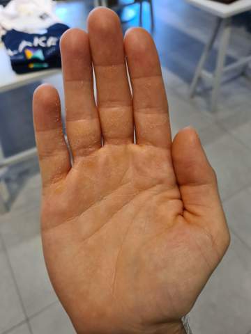Sind Solche Extrem Trockene Hande Normal Eher Zum Arzt Oder Reicht Einfache Handcreme Gesundheit Und Medizin Gesundheit Hand