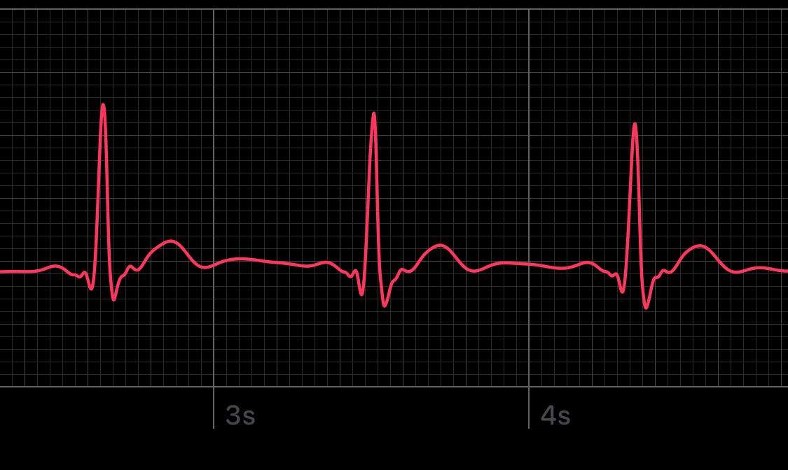 Sinusrhythmus Wie deuten? (Ekg, AppleWatch)