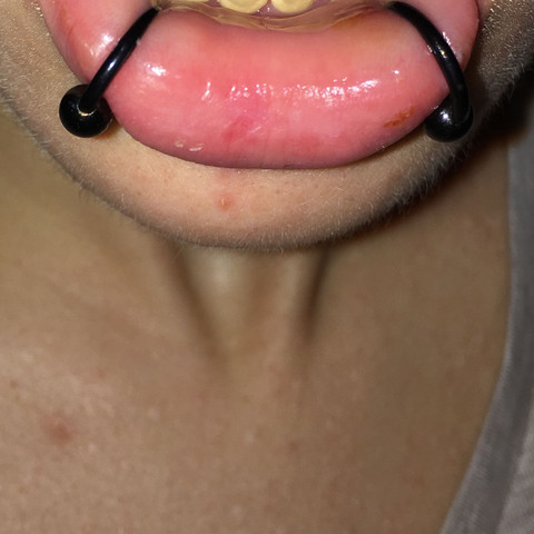 Man sieht auch, dass die Ringe die Lippe deutlich zusammenquetschen - (Piercing, Entzündung, Snakebites)