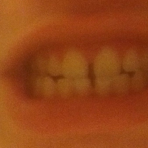 So Eine Zahnlucke Mit Veneers Schliessen