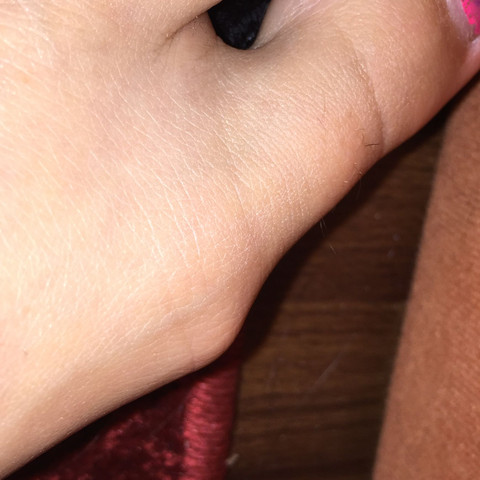 Überbein am Fuß - (Schuhe, Füße, OP)