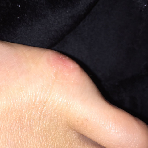Überbein am fuß - (Schuhe, Füße, OP)