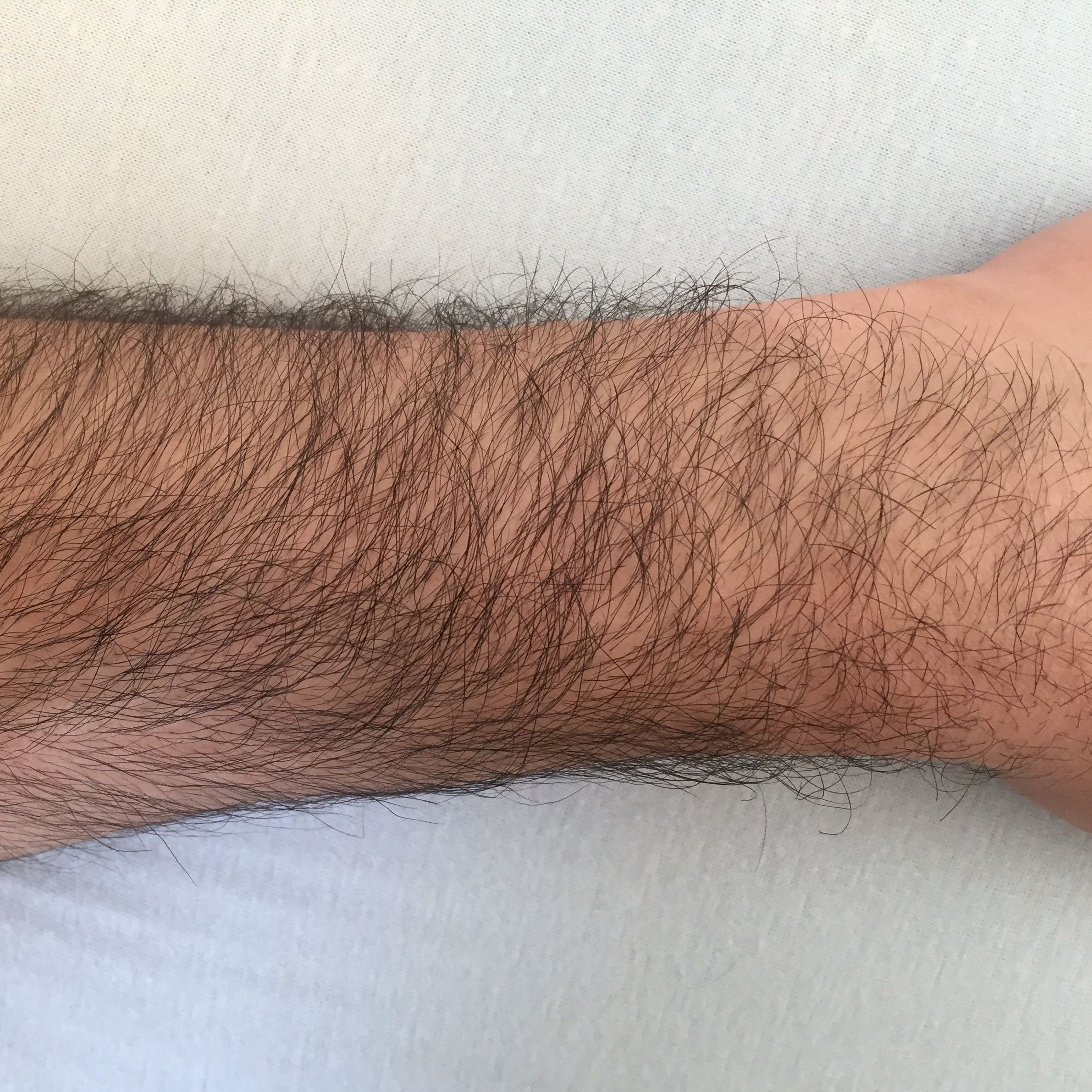 Soll Ich Die Arm Behaarung Rasieren Bin Ein Mann Siehe Bild Harre