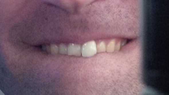Zähne - (Aussehen, Zähne, Zahnersatz)