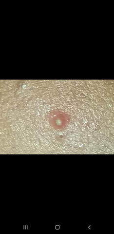 Soll ich diesen Pickel ausdrücken oder nicht? (Medizin)
