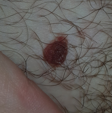 - (Medizin, Arzt, Haut)