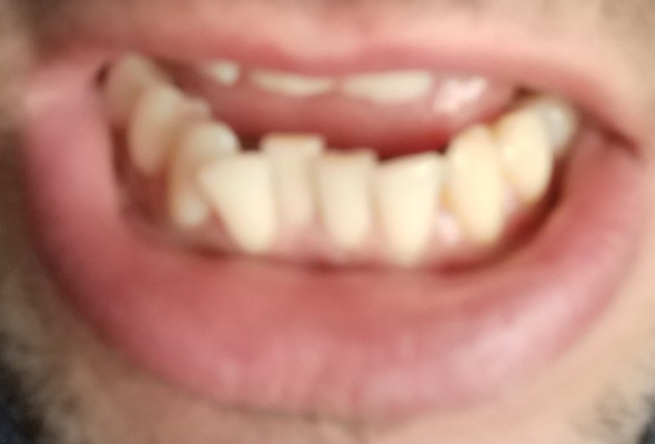 Zähne - (Zähne, Zahnspange, Invisalign)