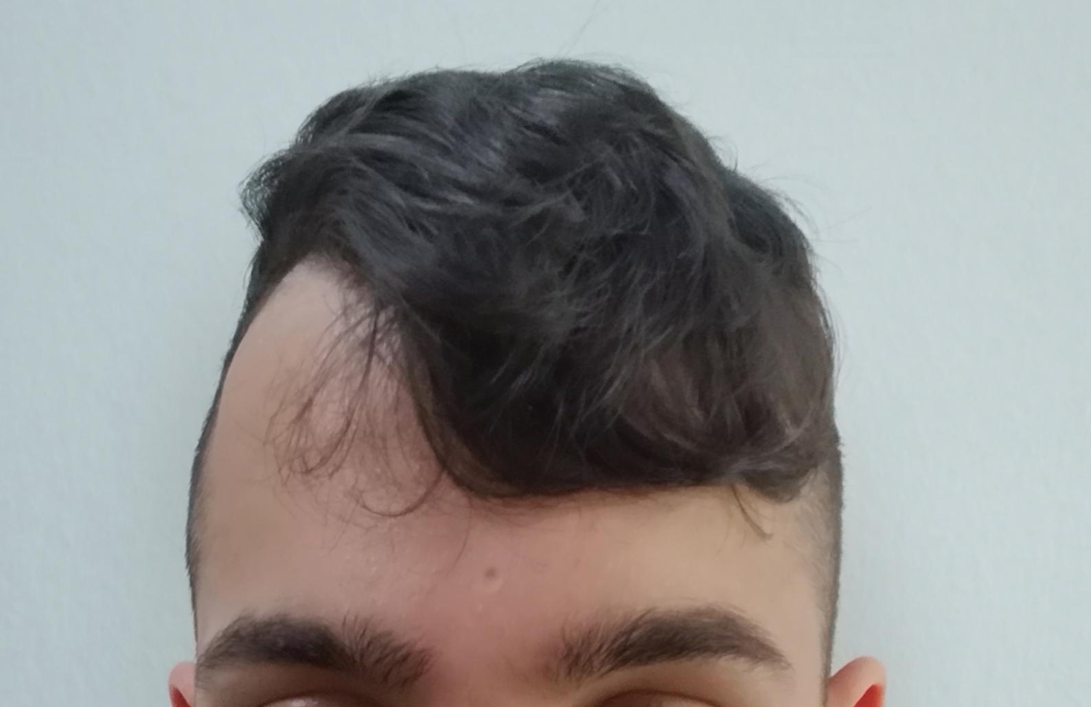 einer haartransplantation unterziehen