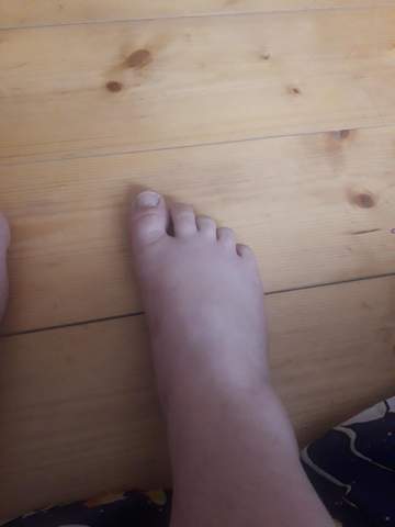 Fuß verstaucht geschwollen