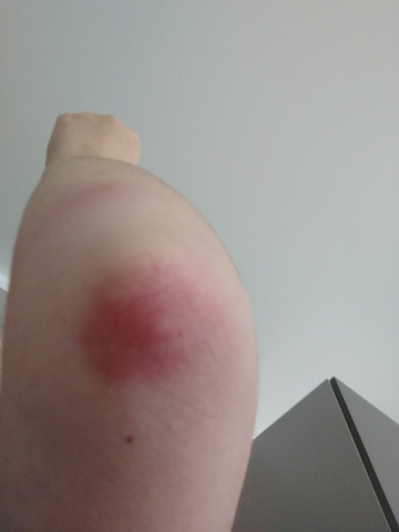 Soll Ich Zum Arzt Gehen Wegen Muckenstich Mueckenstich Soll Ich Zum Arzt Gehen Wegen Muckenstich Mueckenstich