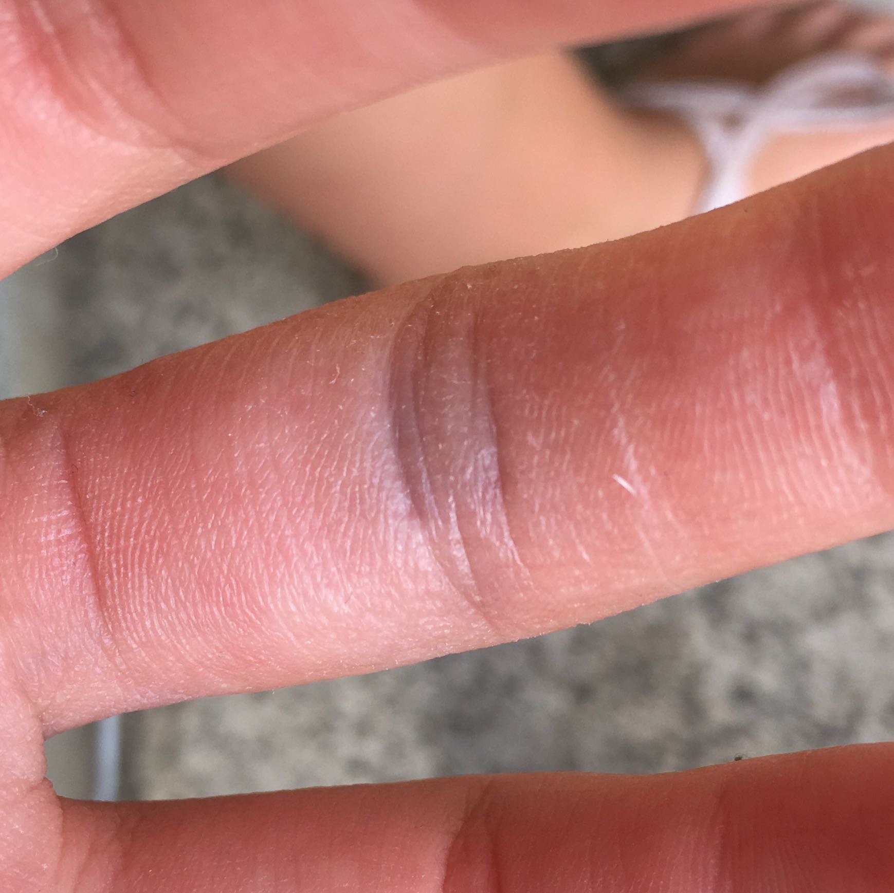 Soll Ich Zum Arzt Wegen Finger Sport Unfall Notfall