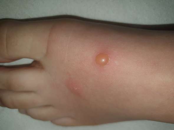 Soll Man Blasen Platzen Fusse Blase Soll Man Blasen Platzen Fusse Blase