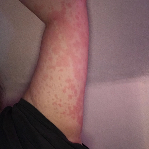 Sollte Es Nicht Besser Werden Antibiotika Ausschlag Cortison Sollte Es Nicht Besser Werden Antibiotika Ausschlag Cortison