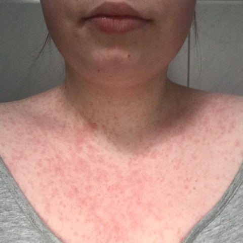 Sollte Es Nicht Besser Werden Antibiotika Ausschlag Cortison Sollte Es Nicht Besser Werden Antibiotika Ausschlag Cortison
