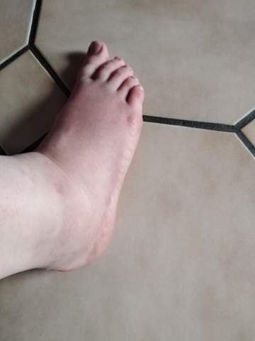 Sollte Ich Damit In Krankenhaus Vorsicht Fuss Gesundheit Und Medizin Gesundheit Fusse