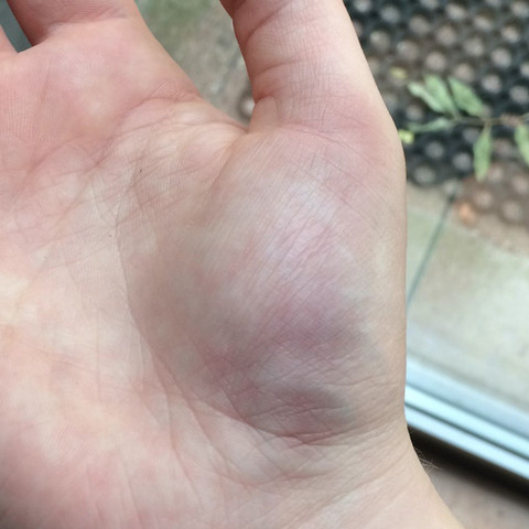 Sollte Ich Den Arzt Aufsuchen Schmerzen Verletzung Volleyball Sollte Ich Den Arzt Aufsuchen Schmerzen Verletzung Volleyball