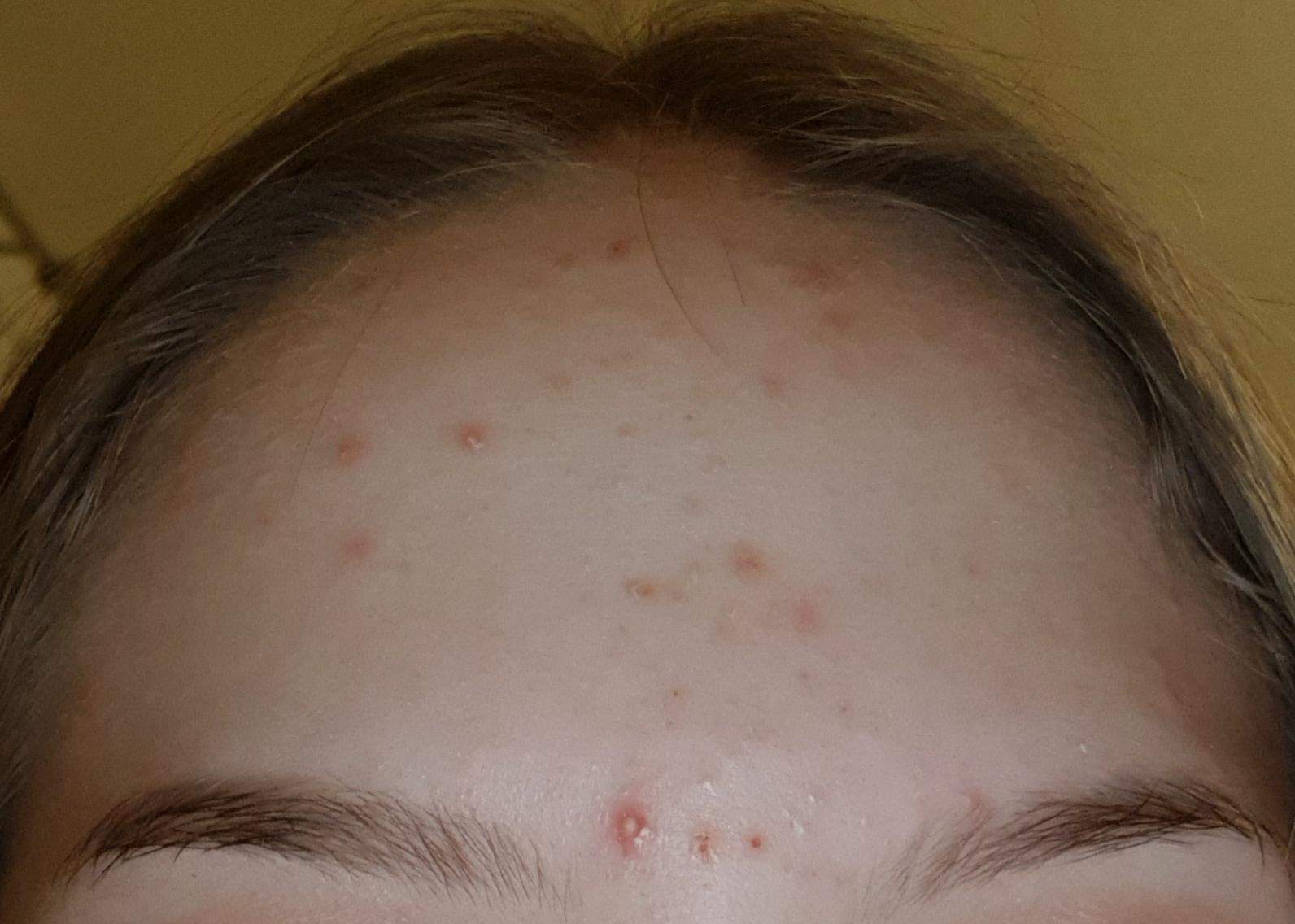 Sollte ich diesen Pickel ausdrücken? (Eiterpickel)