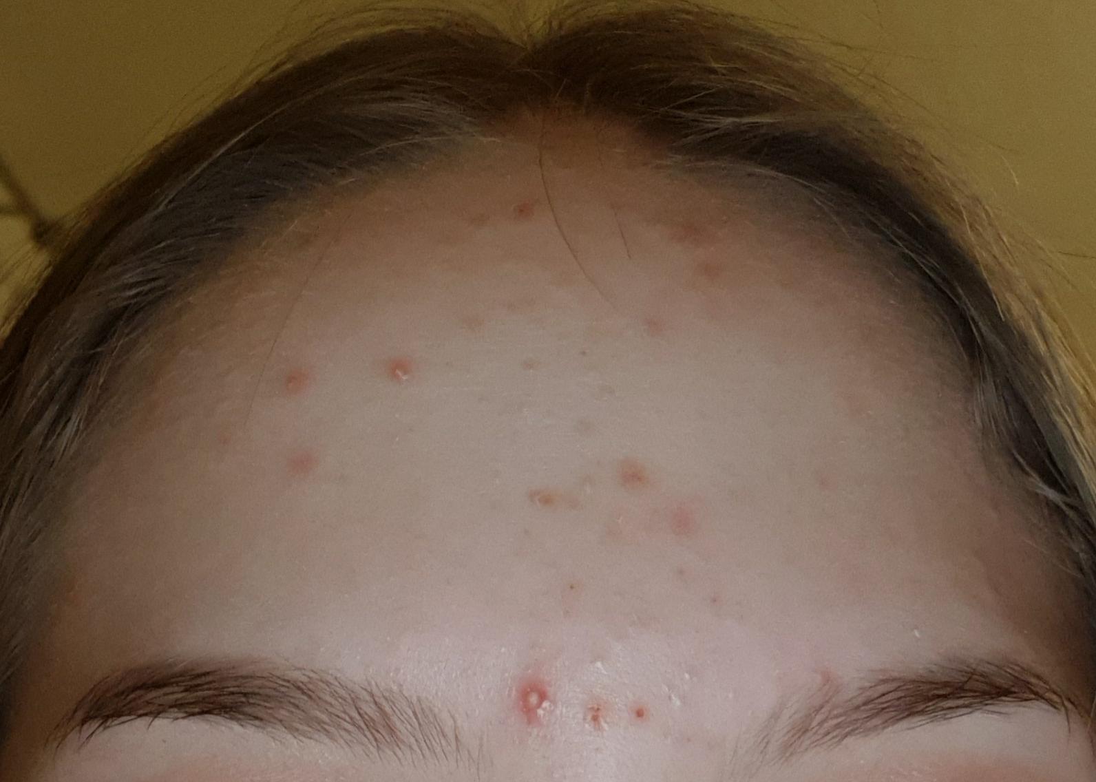 Sollte Ich Diesen Pickel Ausdrucken Eiterpickel