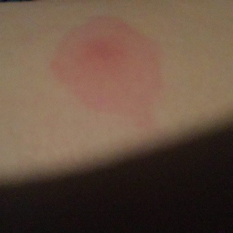 Sollte Ich Mit Diesem Muckenstich Zum Arzt Gehen Medizin Mucken Sollte Ich Mit Diesem Muckenstich Zum Arzt Gehen Medizin Mucken