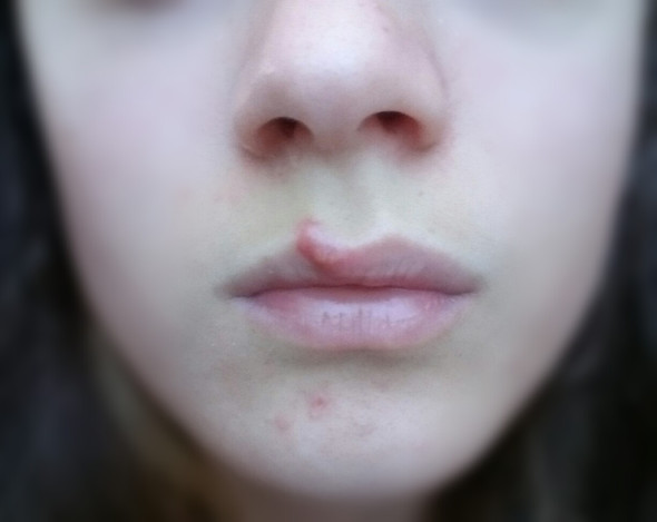 pickel hautarzt pickel hautarzt