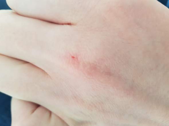 Wichtige Informationen: Wann ist ein Arztbesuch nach einem Katzenbiss ratsam? Wichtige Informationen: Wann ist ein Arztbesuch nach einem Katzenbiss ratsam?