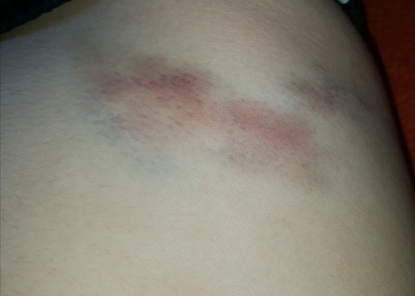 Sollte Ich Zum Arzt Oder Ist Das Ein Normaler Bluterguss Gesundheit Und Medizin Hamatom Sollte Ich Zum Arzt Oder Ist Das Ein Normaler Bluterguss Gesundheit Und Medizin Hamatom