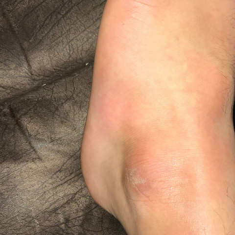 Sollte Ich Zum Arzt Gehen Fuss Umgeknickt Schmerzen Nur Bei Bewegung Gesundheit Und Medizin Sport Und Fitness Fusse